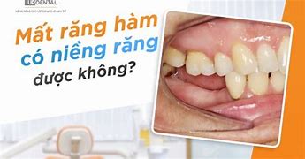 Mất Răng Hàm Có Niềng Được Không